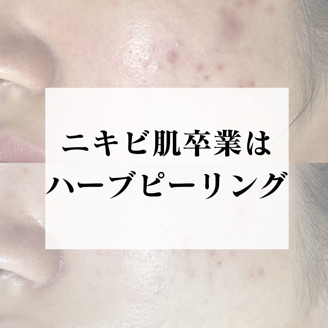 長年の根強いニキビ肌も、ハーブピーリングで改善🌿